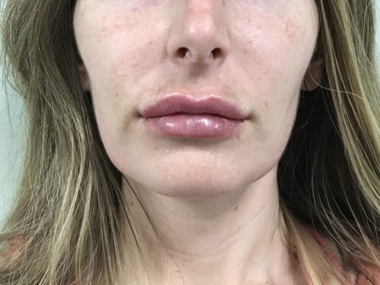 Revanesse Versa Lip Injections Fayetteville, NC Élan Med Spa