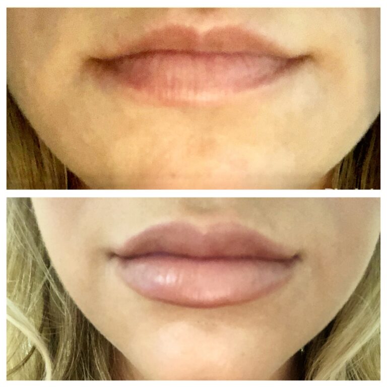 Revanesse Versa Lip Injections Fayetteville, NC Élan Med Spa